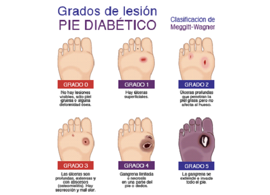 Signos visibles del pie diabético