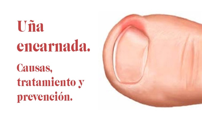 Uña encarnada