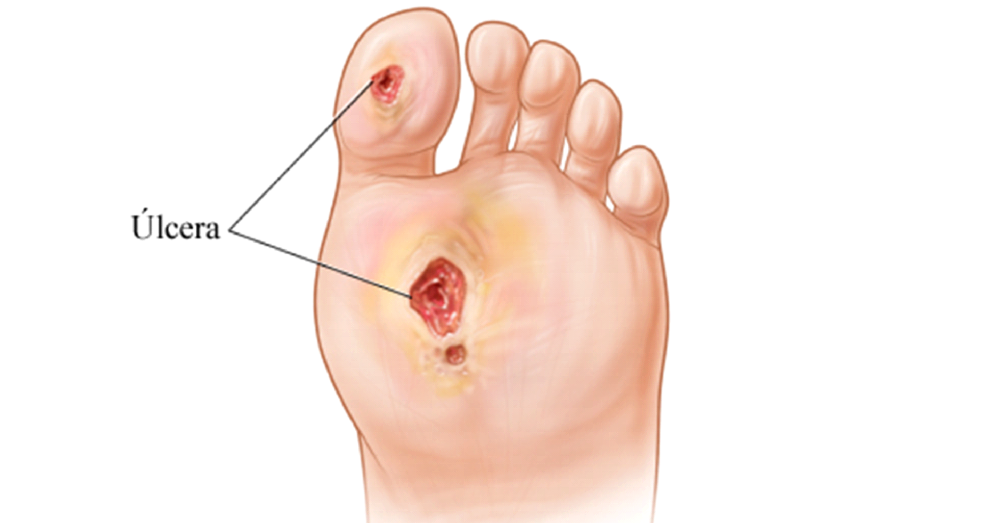 Ilustración de pie diabético con úlceras