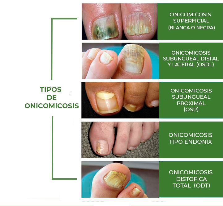 Hongos en las uñas - tiña ungueal y onicomicosis