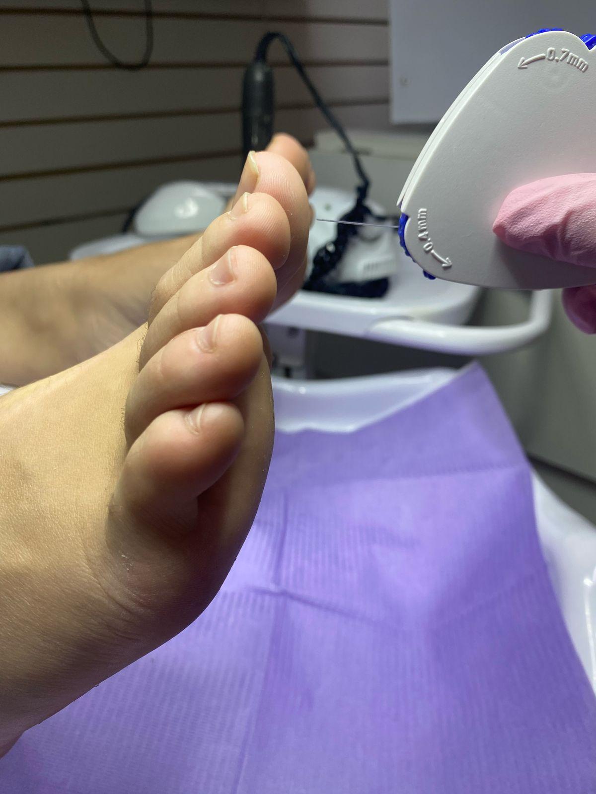 Pie De Atleta - Podología La Plata