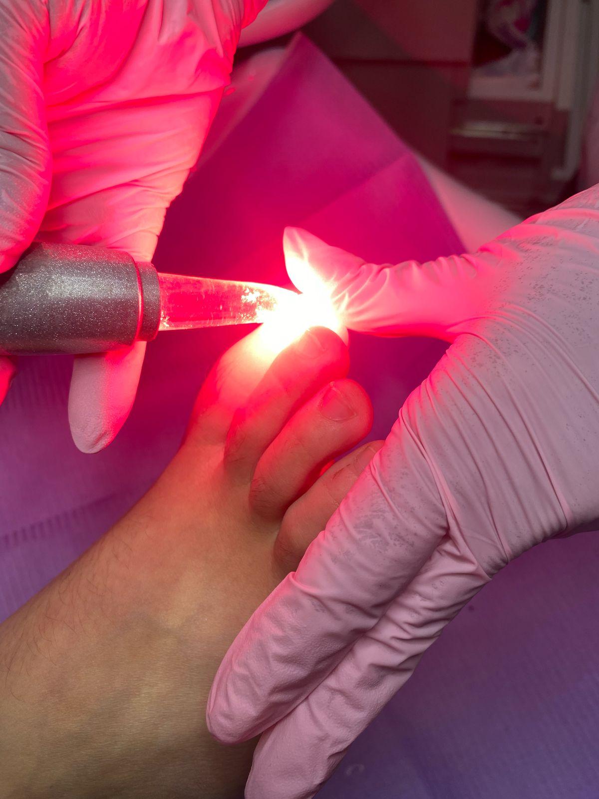 Aplicación de láser en uña afectada por onicomicosis